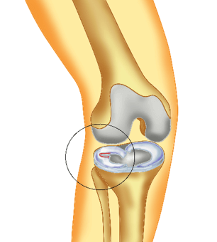 lesioni meniscali