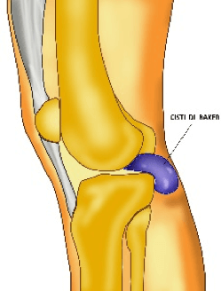 cisti di baker