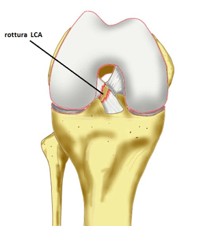 lesioni de legamento