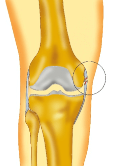 lesioni del legamento collaterale