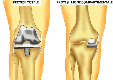 protesi del ginocchio