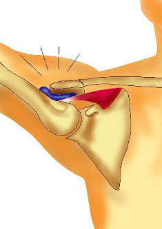 sindrome da impingement